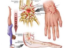 Симптомы и методы лечения вывихов кисти руки: вправление и открытая хирургия