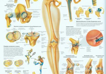 Лечение причин хруста тазобедренного сустава: профилактическое и медикаментозное