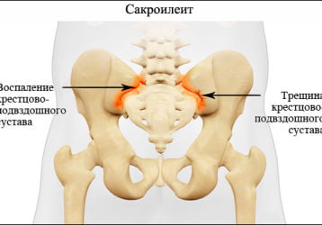 Сакроилеит: лечение инфекционной, неинфекционной, реактивной и ревматической природы