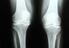 Рентген суставов