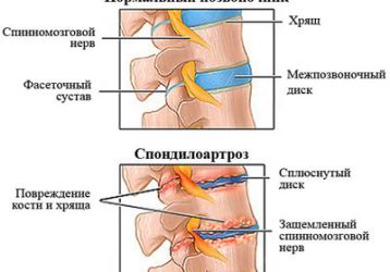 Спондилоартроз позвоночника: признаки заболевания, лечение, упражнения