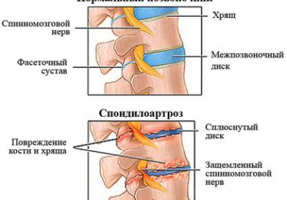 Спондилоартроз позвоночника: признаки заболевания, лечение, упражнения
