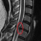 Последствия и послеоперационные осложнения после удаления межпозвоночной грыжи
