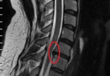Последствия и послеоперационные осложнения после удаления межпозвоночной грыжи