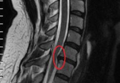 Последствия и послеоперационные осложнения после удаления межпозвоночной грыжи