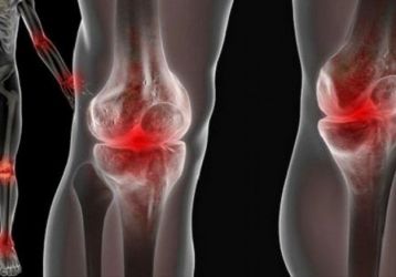 Причины, симптомы и лечение реактивного артрита