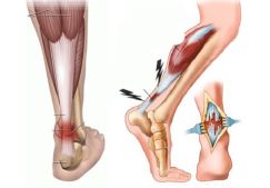 Лечение поврежденных связок голеностопного сустава: способы и сроки восстановления