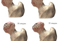 Артроз тазобедренного сустава 2 степени — симптомы и лечение заболевания
