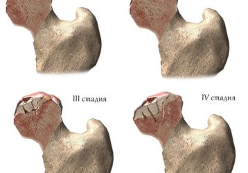 Коксартроз тазобедренного сустава 4-й степени: лечение и операция