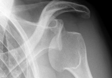 Вывих плеча: причины травм, симптомы и варианты лечения