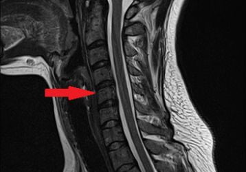 Как правильно спать при шейном остеохондрозе: поза, выбор подушки и матраса