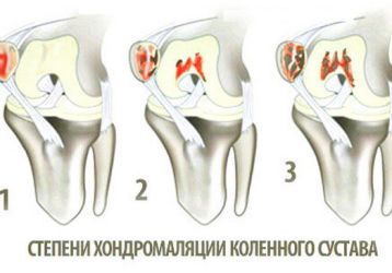 Современный подход к лечению хондромаляции коленного сустава