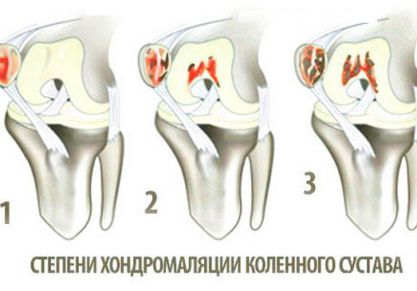 Современный подход к лечению хондромаляции коленного сустава