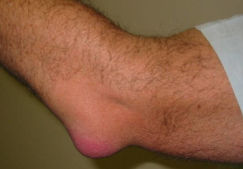 Воспаление локтевого сустава: виды, причины, лечение