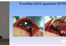 Видео: ревизионное эндопротезирование коленного сустава. Гарайс Д. А. (Сургут)