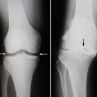 Какие бывают болезни коленного сустава: список самых распространенных