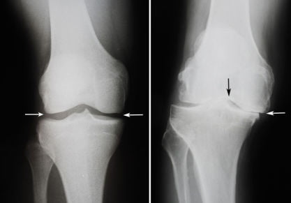 Замена коленного сустава в Москве и Петербурге: клиники и цены
