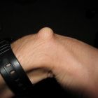 Гигрома запястья: лечение без операции и хирургическое вмешательство