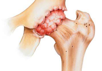 Врач который лечит артроз: ортопед, травматолог, ревматолог