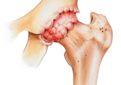 Врач который лечит артроз: ортопед, травматолог, ревматолог