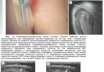 УЗИ плечевых суставов: что показывает и как делается