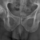 Остеоартроз тазобедренного сустава, лечение, диета, упражнения