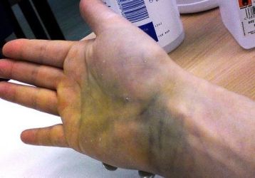 Растяжение связок запястья: симптомы и лечение травмы