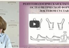 Видео: результаты эндопротезирования локтя при ревматоидном артрите. Роскидайло А.А.