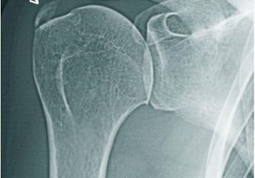 Причины, симптомы и лечение плечелопаточного периартрита