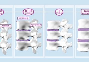 Симптомы, диагностика и лечение шейного остеохондроза 1 степени