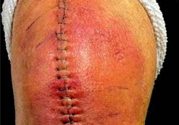 Боли после эндопротезирования коленного сустава — стоит ли паниковать?