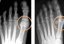 Подагра на ногах: лечение в домашних условиях народными средствами