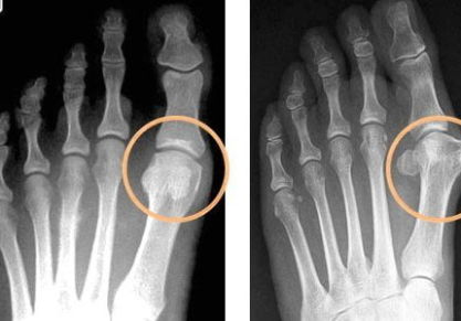 Подагра на ногах: лечение в домашних условиях народными средствами