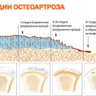 Генерализованный остеоартроз: лечение первичного и вторичного типа