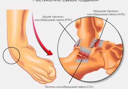 Срок восстановления разрыва и растяжения связок голеностопного сустава