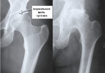 Какой врач лечит коксартроз тазобедренного сустава: от диагностики до операции