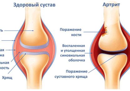 Как лечить воспаление коленного сустава