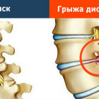 Как предупредить образование грыжи позвоночника: профилактические меры