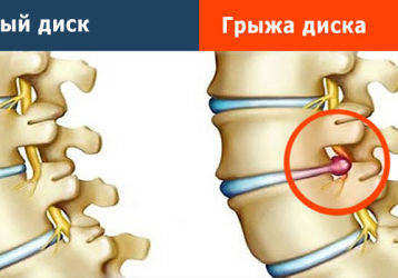 Как предупредить образование грыжи позвоночника: профилактические меры