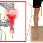 Тендинит коленного сустава или воспаление сухожилий: лечение, причины, симптомы