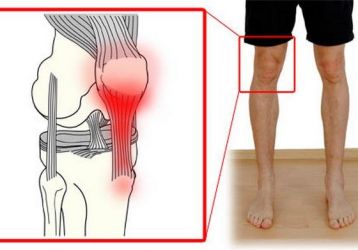 Тендинит коленного сустава или воспаление сухожилий: лечение, причины, симптомы