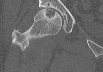 Киста тазобедренного сустава: симптомы и лечение