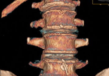 Медикаментозное лечение симптомов поясничного остеохондроза