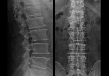 Грудной остеохондроз: лечение в домашних условиях, как лечить недуг