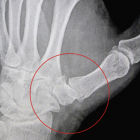 Артроз большого пальца руки: лечение медикаментами и физиотерапия