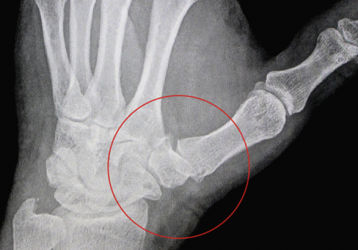 Артроз большого пальца руки: лечение медикаментами и физиотерапия