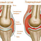Детский артрит коленного сустава: симптомы и лечение