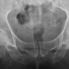 Эндопротезирование тазобедренного сустава: цена и условия