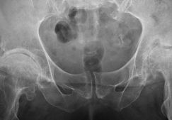 Эндопротезирование тазобедренного сустава: цена и условия