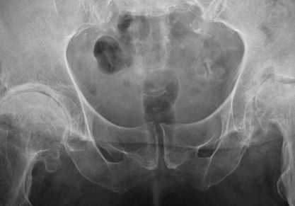 Реабилитация после замены тазобедренного сустава: упражнения и гимнастика